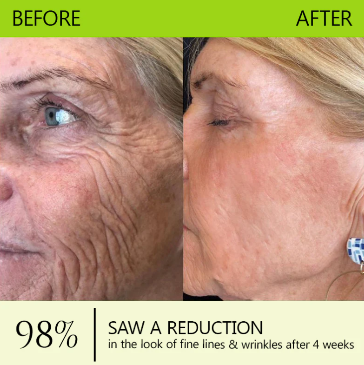 [🌸 Mother's Day Sale 70% OFF] ODALIT™ Botox & Retinol Shot - Eraser for Deep Wrinkles, Sagging Jowls & Puffy Eyes