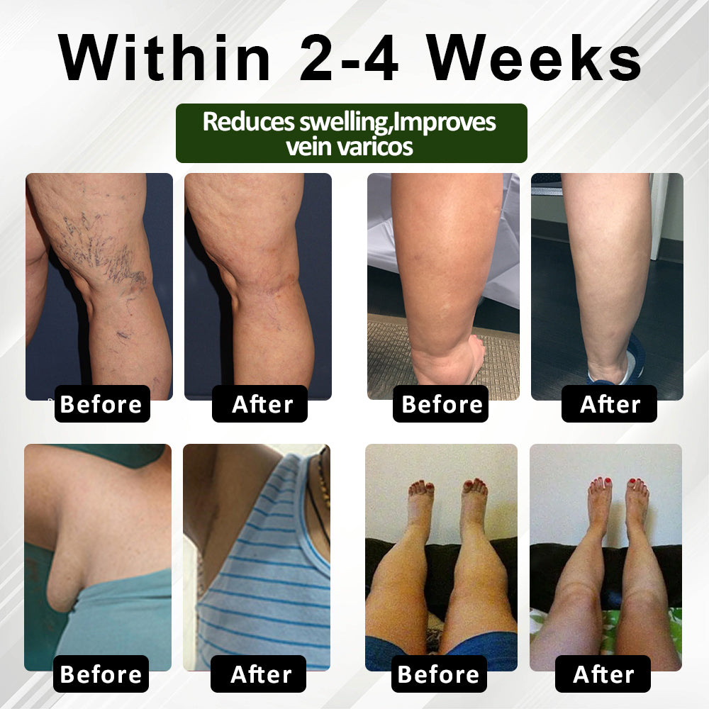 TAILEDEN™ FluidEase Leg Therapy Edema Cream