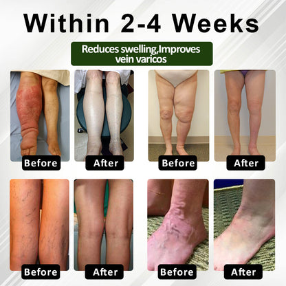 TAILEDEN™ FluidEase Leg Therapy Edema Cream